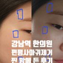 내맘에한의원 | 강남역 한의원 편평사마귀제거 찐 맘에 든 후기
