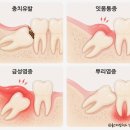 은계퍼스트치과의원 | 은계지구 치과 사랑니 발치, 무섭다는 후기가 사실일까