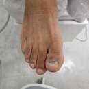 [이천/증포동] 무좀발톱 &#34;이천 문제성 발 전문 라파엘&#34;