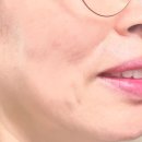 디자인쓰담 | 청담동 피부과 쥬브젠 자가진피재생술 팔자주름 마리오네트 비용 통증 후기 내돈내산 에이스