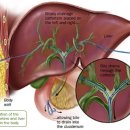 경피경간 담도 배액술[percutaneous transhepatic biliary drainage, PTBD] 이미지