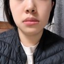 하당건강의료기 | 갑상선암 수술 기록(3) : 수술 후 일상, 첫 외래 (보라매병원 채영준교숨 경구강 내시경 수술, 목절개)
