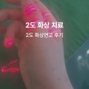 2도 | 2도 화상연고 후기 손가락 2도 화상 치료 비아파인 응급처치 과정