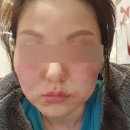 자작나무치과의원 | 루나의원 루비레이저 후기 (내돈내산)