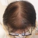 압구정소망약국 | 탈모예방약을 먹으면 도움이 되나요?