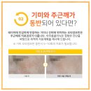 기미잡티 제거 레이저 시술 관련 후기 (팩 아님)