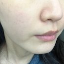 아우라지장 | 압구정 울페이셜 리프팅 셀럽관리 솔직후기