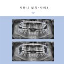 가온의원 | 옥정치과추천 안아픈 사랑니 발치 후기, 연세가온치과 -31