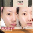 세포마을 | [공지] 줄기세포주사 리쥬란 후기 (피더린으로 효과 제대로 보는법, 통증, 유지기간, 가격)