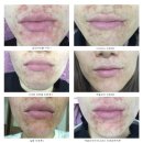 연세비비의원 | 전주연세비비의원 성인여드름치료 진행중 후기 - 유셀(U-cell) 고주파로 피부재생관리