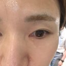 리쥬란 힐러 후기ㅣ 명동 갤러리피부과 30대 효과 추천 (일상생활 및 통증)