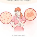 빈대 물린자국 증상 특징 퇴치 방법 빈대 물리면 대처법 이미지