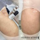 메디케어 코리아 | 노출의 계절, 튼살관리 제대로 받고 싶다면?