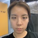 [리뷰] 리투 / 청담 피부과 / 청담 리프팅 / 튠페이스 시술 / 리프팅 피부과 / 튠페이스 후기