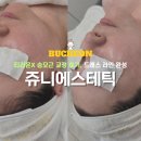 쥬니 | 부천 웨딩관리 쥬니에스테틱｜티리온X 승모근 교정 후기, 드레스 라인 완성