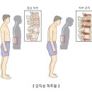 강직성 척추염Ankylosing spondylitis근골격질환 이미지