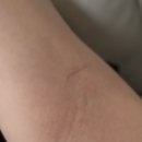 작은팔 | 피부과 CO2 레이저로 안 빠지던 팔 섬유종, 결국 성형외과 수술 후 2달 경과 후기_오체안성형외과 신사