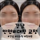 아침나무한의원 | 강남안면비대칭 교정:: 사진 찍을 때마다 스트레스였던 안면비대칭 한의원 교정 솔직 후기