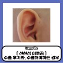 선천성 이루공 수술 후기, 수술 해야할 경우