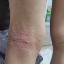 유산균 건강카페 | 드시모네 4500 프로바이오틱스 유산균 : 아토피 3주 섭취 찐 후기