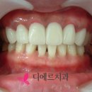 스마일라인치과기공소 네이버블로그