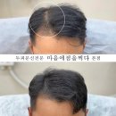 마음에점을찍다두피SMP 이미지