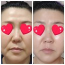 안산 더블 인셀덤 7일프로그램 후기 ❤️
