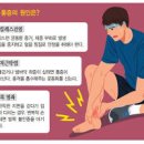 발목 아플때 발목염좌 발목염증 붓기 찜질 통증 원인 이미지