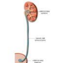 약손간병 | 1편) 19cm 자궁 혹 발견 그리고 요관 스텐트 시술 후기
