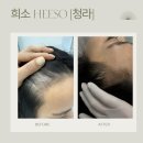 다르헤어 | 인천두피문신 찾는다면? [루원시티 희소 SMP] 1회차 솔직후기