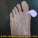 몆년전에 무지외반증 수술하였는데 요즘 지간신경종이 발생하여 발바닥이 아파요 이미지