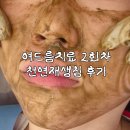 2 | 대구여드름한의원 2회차 후기 천연재생침 동성로피부관리