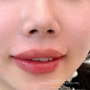 립라인스튜디오 | 마곡 발산 다크립 개선 + 세미오버립 립라인 교정 후기 (뉴트럴톤 립) :: 마곡 입술 / 온데이스튜디오