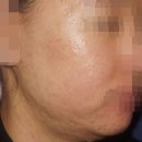 노원지루성피부염 모낭염 치료에 최선을 다하는 하늘체한의원 후기