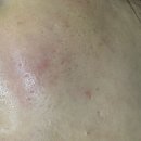 연세샘가정의원 | 연희동 일요일 진료하는 연세봄봄의원 피코프락셀 3차 후기 내돈내산