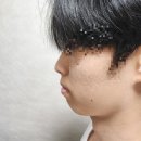 치아교정하러갔다 코밑 과잉치발견