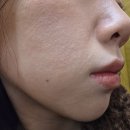 원플러스25 서면제일점 | 부산 서면 피부과 스킨부스터 셀르디엠 내돈내산 비포에프터