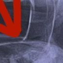 서울치과병원 | 매복사랑니 발치 후기 서울대학교치과병원 서병무교수님