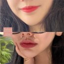 사진병원 | 입술확대수술 후기 - 확대전후사진포함, 병원선택팁 정리