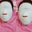 슈퍼스타피부과의원 | 슈퍼스타피부과 밀크필 필링 후기