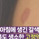 고정반점 이미지