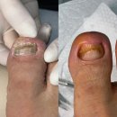 발건강 | 구로 내성발톱 전문 케어, 아버지 발 건강 되찾은 후기! 바디코스 손발톱케어 구로점