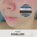 온아뷰티 | 천안 스킨케어수기전문점 피지모공MTS관리 온아에스테틱 솔직후기