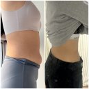 (주)메리트플러스에이엠씨 | 복부지방흡입 붓기 관리방법 및 2개월차 전후비교 후기