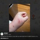 비타민한의원 | [하늘마음한의원]천안아산점 결절성양진 내돈내산 2년전 치료 후기