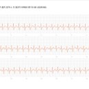 심방세동 재발 현황 보고 이미지