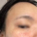 빌리브피부과의원 | 출산 후 피부 변화, 주사피부염 치료 후기 (범어네거리 빌리브 피부과 추천)