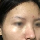 우방약국 | 검버섯 흑자 제거 비용 홈케어 흑자셀프제거 후기 효과 부작용