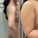 팔골 | 팔지방흡입 병원 • 가격 정보 , 한달차 변화 솔직후기