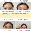 청주보톡스/휴먼피부과청주/이마보톡스/미간보톡스/보톡스후기